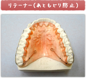 リテーナー（あともどり防止）