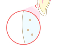 ホワイトニングのメカニズム ③