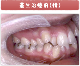 叢生治療前(横)