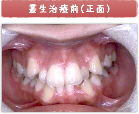 叢生治療前(正面)