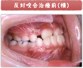反対咬合治療前(横)