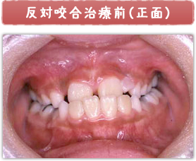 反対咬合治療前(正面)