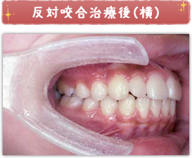 反対咬合治療後(横)