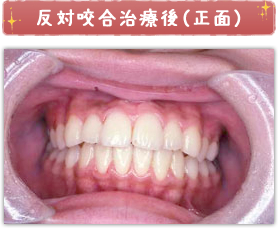 反対咬合治療後(正面)