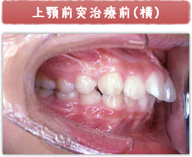 上顎前突治療前(横)