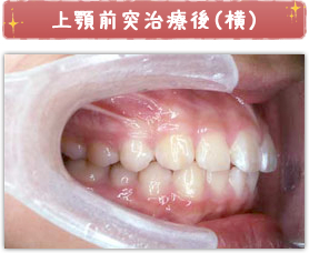 上顎前突治療後(横)